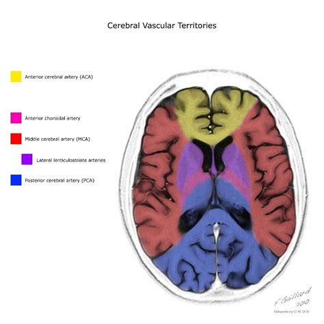 Cerebral Vascular Territories Radiology Case