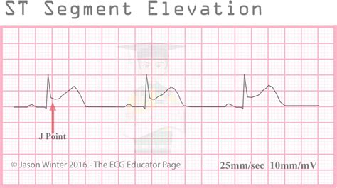 Ecg Educator Blog St Segment Elevation Morphologies