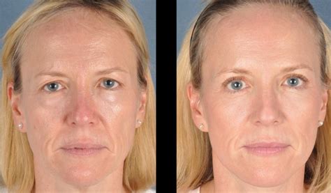 The Facelift Workouts Guide For Women And Men Eradicate Saggy Hog