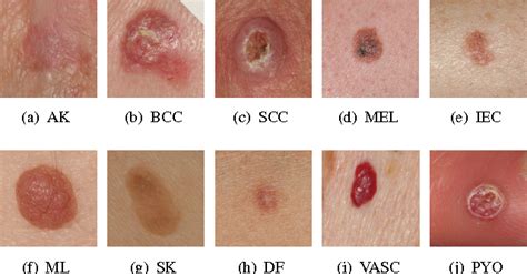 Hierarchical Classification Of Ten Skin Lesion Classes Semantic Scholar