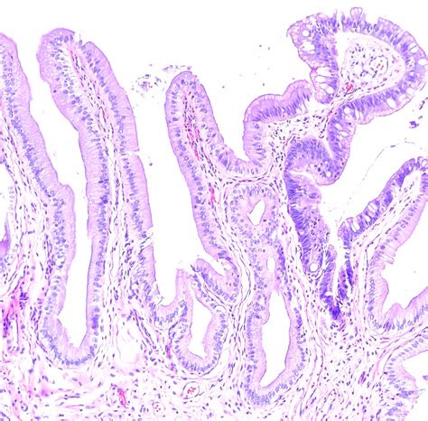 Low Grade Biliary Intraepithelial Neoplasia Of The Gallbla Flickr