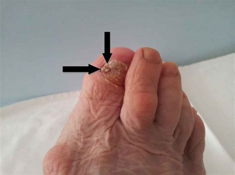 Melanoma Foot