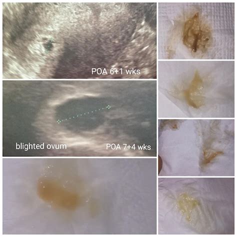Light Brownish Discharge At 6 Weeks Pregnant