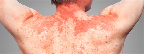 Alergia Al Sol Causas Síntomas Y Tratamientos