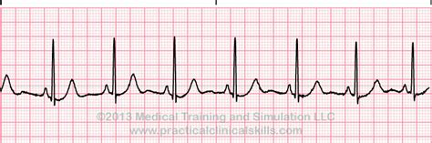 Normal Sinus Rhythm ECG Interpretation With Sample Strip