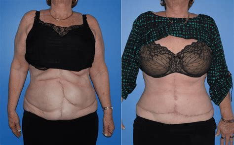 Stomach Incisional Hernia Before And After Pictures Melanieausenegal
