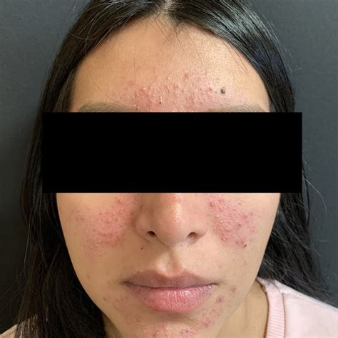 Mild Background Of Persistent Erythema After 3 Months Of Treatment With