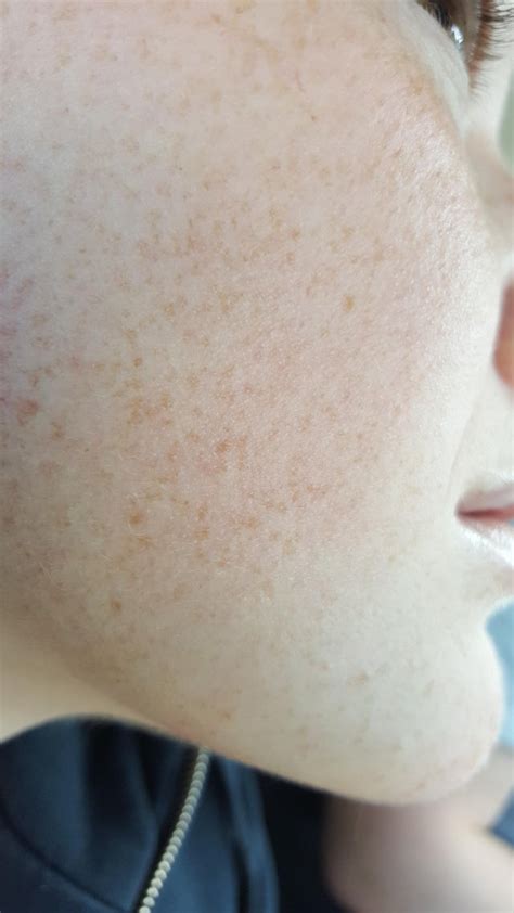 Skin Concerns Ive Had Bumps On Face For A While Sometimes Dry And