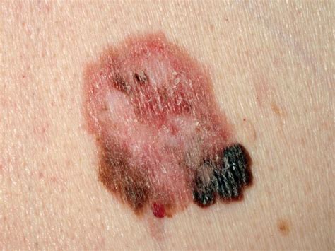 Malignant melanoma) genannt, ist eine hochgradig bösartige (maligne) entartung der pigmentzellen (melanozyten). Schwarzer Hautkrebs: Wie entsteht ein malignes Melanom ...