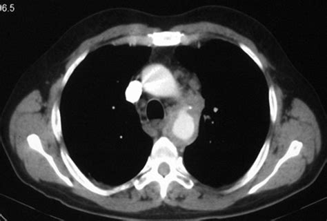 Ct Scans Reduce Lung Cancer Deaths By 20 Percent