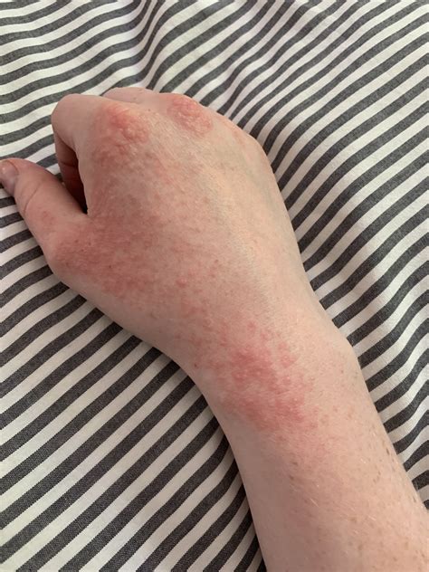 Rash On Hands After Sun Exposure Doxycycline Askdocs