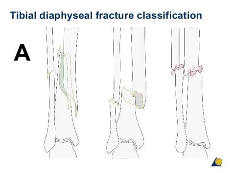 Tibial Diaphyseal Fracture