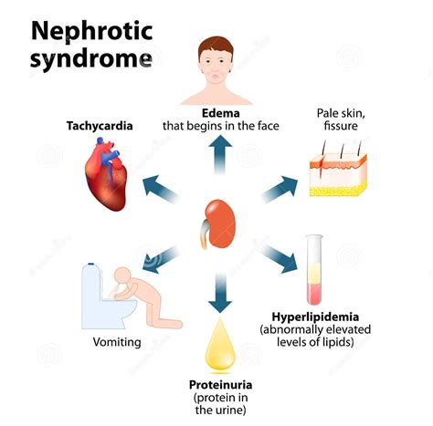 Prepare For Medical Exams Causes Of Nephrotic Syndrome