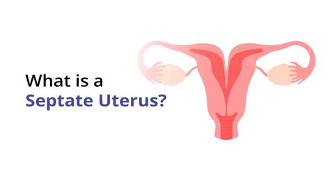 Understanding Septate Uterus Causes Symptoms And Treatment Birla