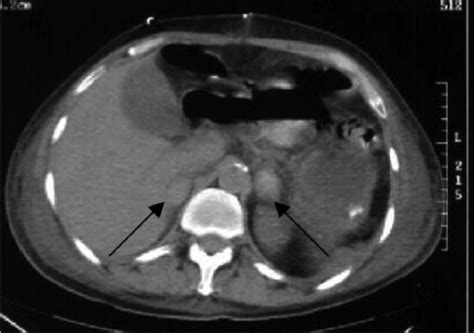 Ct Scan Of The Abdomen And Pelvis Arrows Demonstrate B