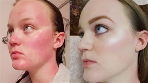 How To Cover Up Sunburn With Makeup