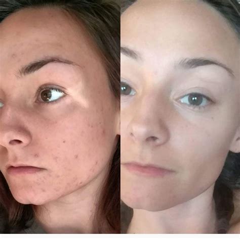 Pea Vie Bone Broth Skin Before And After