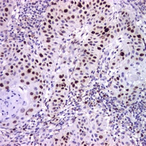 Vegf Moderately Differentiated Squamous Cell Carcinoma Vegf