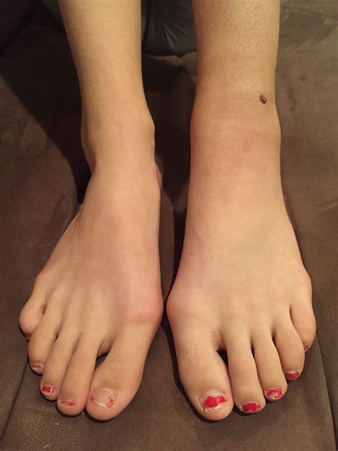 Injury, overuse or conditions causing inflammation involving any of the bones, ligaments or tendons in the foot can cause foot pain. The Foot Comparison - Kyah's Journey