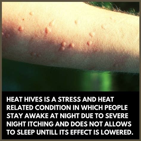 What Is Your Personal Experience Of Heat Hives Quora