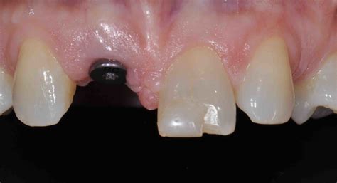 What Is Dental Implant Abutment Dental News Network