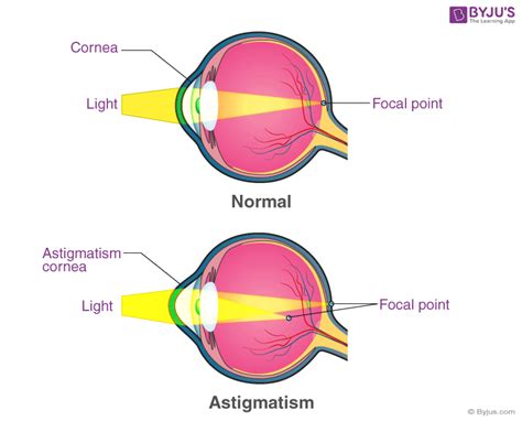 Astigmatism Causes Of Astigmatism And Types Of Astigmatism Byjus