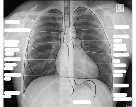 Anatomy Of Chest X Ray : CXR Anatomy. | Radiology student, Medical