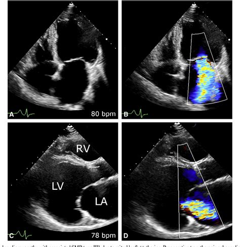 Figure 2 From Secondary Mitral Regurgitation Repair Techniques And