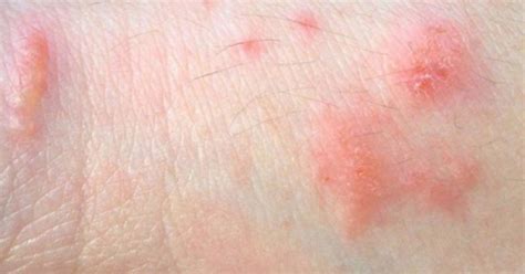 Salah satu yang paling sering terjadi dikarenakan alergi terhadap jenis makanan atau selanjutnya, pisahkan kulit dan isinya yang berupa gel dengan tekster yang kenyal. Macam Macam Alergi Kulit Dan Gambarnya - Mutakhir
