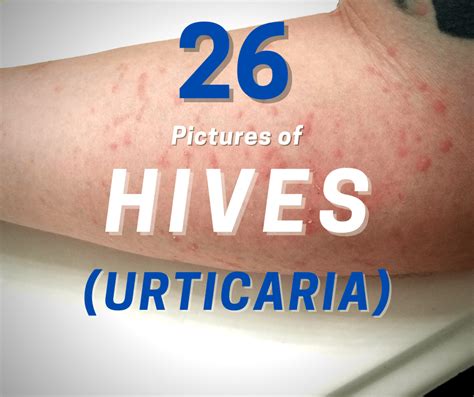 37 Detailed Pictures Of Hives On Skin Allergy Preventions Food