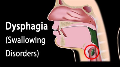 Dysphagia Causes Symptoms Diagnosis Diet And Treatment