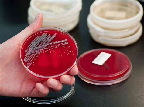 Mrsa Types Symptoms Causes Diagnosis Treatment And More
