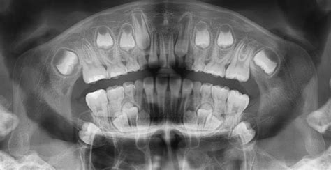 Panoramic Radiographic Image Of The Patient At The First Visit Showed