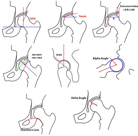 Developmental Dysplasia Of The Hip Radsource