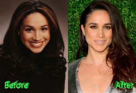 Meghan Markle Nose Job A Look For The Princess To Be