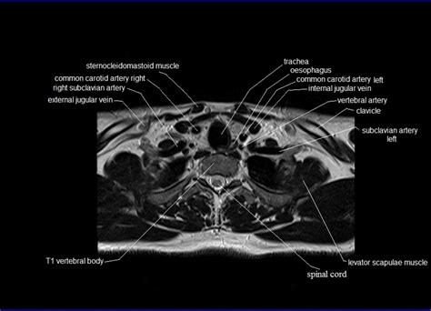 Department of histology, jagiellonian university medical under the stereo microscope (and depending on the section of the bone under investigation) the. MRI neck anatomy | free MRI axial neck cross sectional anatomy