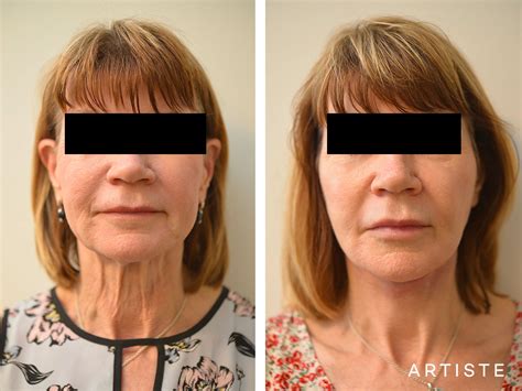 3 Signs You Need A Neck Lift Artiste Plastic Surgery