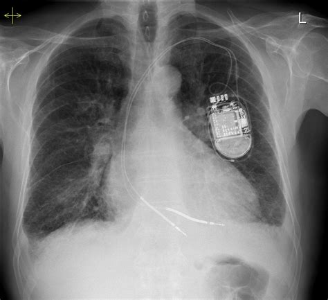 Check the full list of possible causes and conditions now! Pulmonary oedema - Kerley B lines - Radiology at St ...