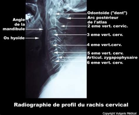 Rachis cervical radiographie de profil avec légendes Imagerie