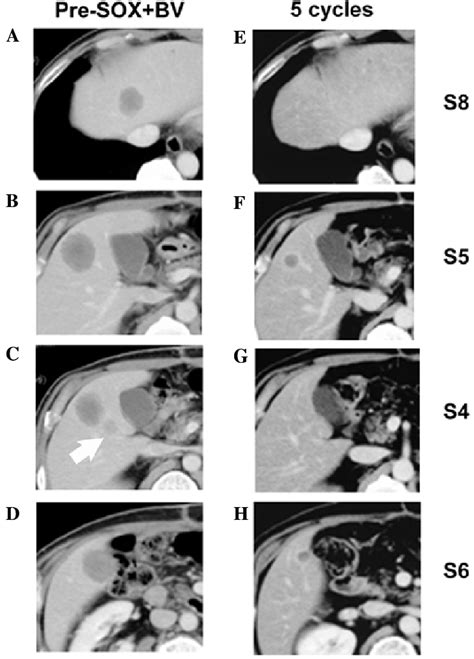 Abdominal Computed Tomography Ct Scan Showing Low Density Areas In