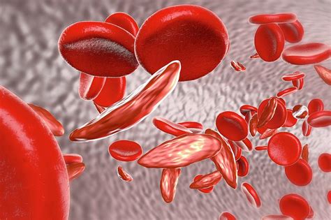 Sickle Cell Anaemia Photograph By Kateryna Konscience Photo Library