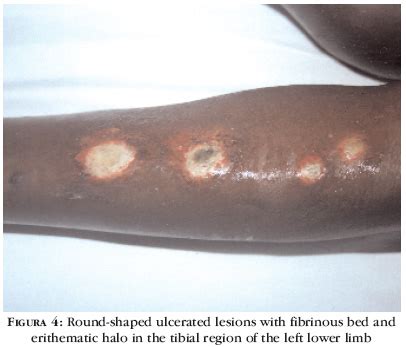 Martorell hypertensive ischemic leg ulcer (martorell ulcer) is characterized by distinct alterations in the arteriolar wall of subcutaneous vessels, leading to progressive narrowing of the vascular lumen and. Martorell's hypertensive ulcer: case report