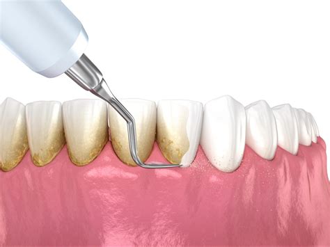 Scaling And Root Plaining — Kosh Dental