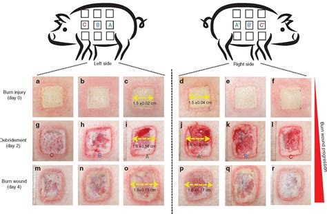 Dual Therapeutic Functions Of F 5 Fragment In Burn Wounds Preventing