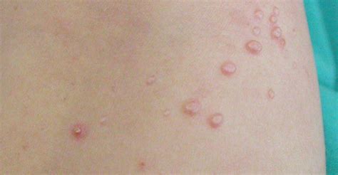 warts molluscum contagious genital herpes clínica dermatológica murcia openderma