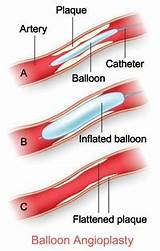 A Balloon Angioplasty Is Used To