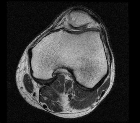 A medial meniscus lesion is often a concomitant injury associated with chronic acl tears while a lateral meniscus lesion may be sustained during an acute acl lesion4. Knee - wikidoc