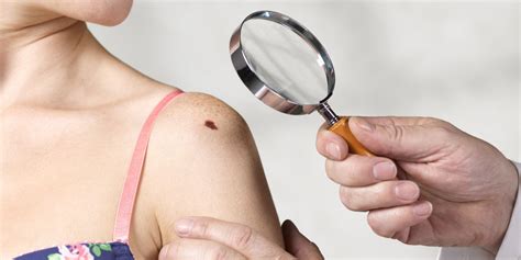 Symptoms of metastatic melanoma other than a mole Surprising Skin Cancer Facts - Facts You Should Know About ...
