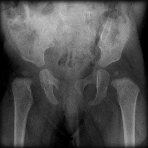 Pelvic X Ray Normal Different Ages Image