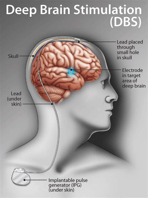 deep brain stimulation the defeating epilepsy foundation